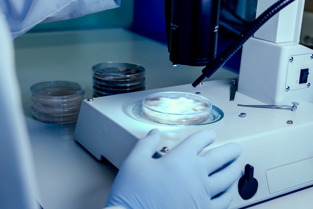 YODA research in multiple system atrophy (MSA)